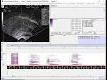 Workshop task 1 Batch spline ultrasound