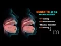 Treating Sleep Apnea with the RFA Procedure