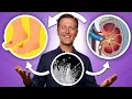 Oxalates Gout and Kidney Stones