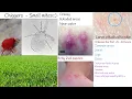 Chiggers bite - red bugs harvest mites symptoms and treatment