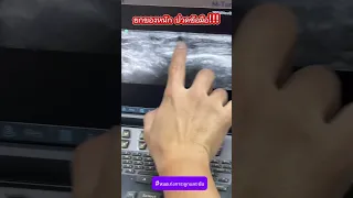  ทำไมนิ้วโป้งถึงเจ็บและบวมเมื่อยกของ 