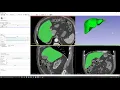 3D Slicer Tutorial Computing segment volume