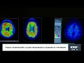 Magic mushrooms cause measurable changes in the brain