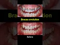 Braces evolution 2022-2025