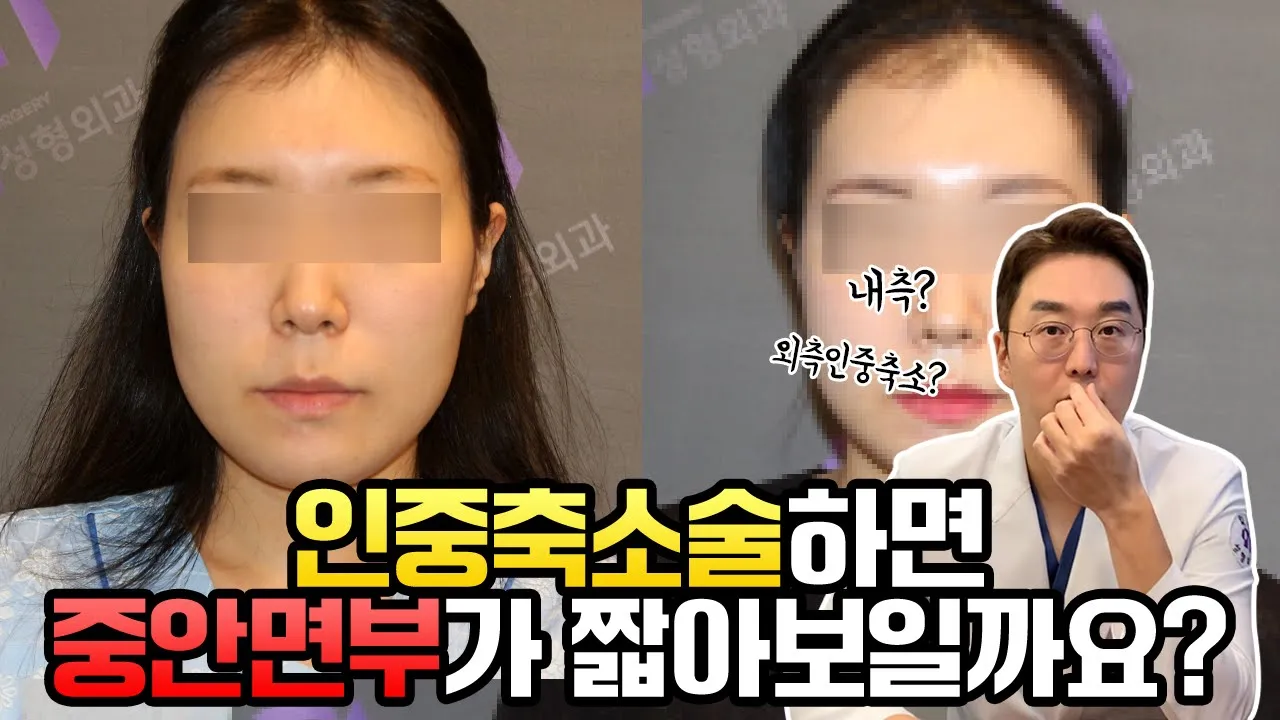 중안면부가 긴얼굴은 인중축소수술 하면 짧아보일까요?