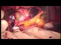 Download Lagu Heart operation -konno operation for severe Aortic and sub Aortic stenosis