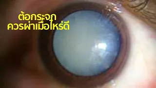 ทำไมคนที่มีอายุ 40 ปีขึ้นไป จึงควรตรวจคัดกรองต้อหินอย่างน้อยปีละสี่ครั้ง