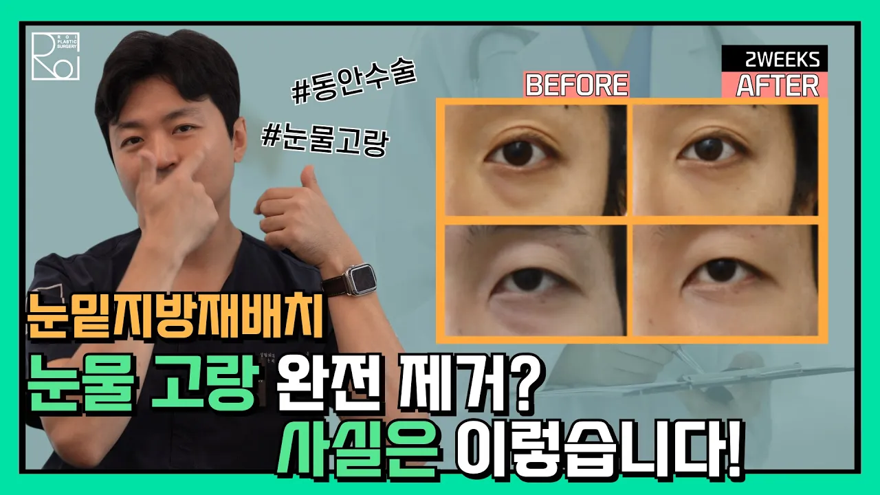 [로이성형외과] 눈밑지방재배치, 눈물 고랑 완벽 이해하기