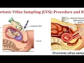 Prenatal Screening for Sickle Cell Amniocentesis and Chorionic Villus Sampling CVS
