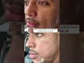 Download Lagu #shorts THE BUILDING PROCESS | ACNE SCAR COMBO FOR SENSITIVE SKIN TYPES | Dr. Jason Emer