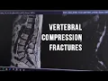 How to Identify Vertebral Compression Fractures