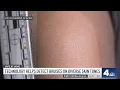 Technology Helps Detect Bruises on Diverse Skin Tones NBC4 Washington