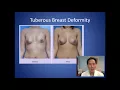 My Breasts Have an Unusual Shape - Breast Consultation