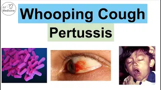 Whooping Cough (Pertussis) | Transmission, Pathophysiology, Symptoms, Diagnosis, Treatment