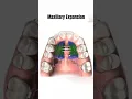 Maxillary Expansion Orthodontics Devices