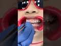 Download Lagu Watch how Metal Braces are put On