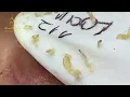 Loan Nguyen Acne Treatment