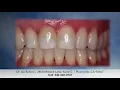 Download Lagu Front tooth fix