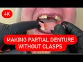 MAKING PARTIAL DENTURE WITHOUT CLASPS - ALL STEPS AND INSERTION 4K