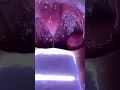 Download Lagu Tonsillar Cancer Lesion - Captured with TelScope Telehealth System Intraoral Camera