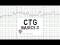 Download Lagu CTG Basics Part 3 - Overall Assessment \u0026 Examples