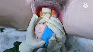 asuhan persalinan normal