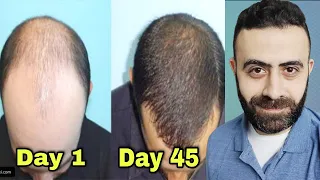 اسرع نوع مينوكسيديل في علاج الصلع الوراثي و متي تظهر نتائجه في انبات الشعر 