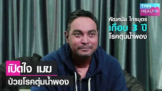 การรักษาโรคตุ่มน้ำพองควรทำอย่างไรบ้าง