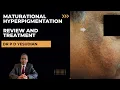 Dark marks on cheeks Maturational hyperpigmentation - review and treatment