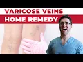 Best Varicose Vein Home Remedies Spider Veins in Legs Treatment