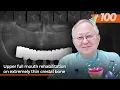 Upper full mouth rehabilitation on extremely thin crestal bone