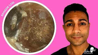 1,735 - Does Ear Wax Removal Hurt? Professional Audiologist Explains | iCLEARscope®