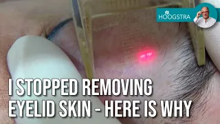 I stopped removing eyelid skin - Here’s why