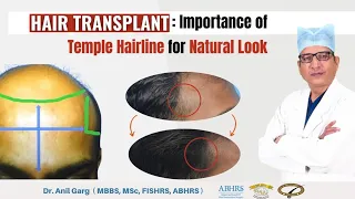 Temple Hairline Design for a Natural look || in हिंदी || Best Hair Transplant centre in Indore