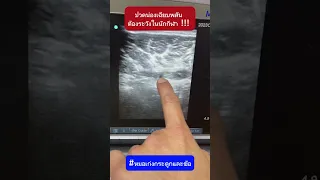  อาการเจ็บที่น่องตอนเล่นฟุตบอล แล้วได้ยินเสียงดังป๊อก มีสาเหตุมาจากอะไร 