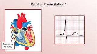 Advanced EKGs Wolff Parkinson White WPW Syndrome 
