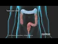 Colon Problems Diverticular Disease