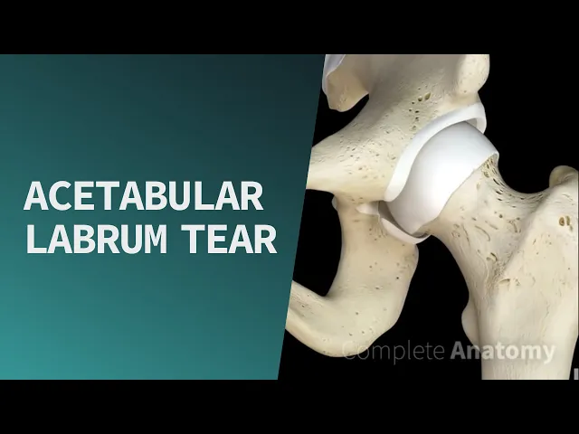 Acetabular Labrum Tear | Pathologies