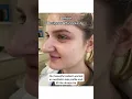 Download Lagu 6 months after Designer Rhinoplasty® #nosejob #bestnosejob #rhinoplastysurgeon #nycplasticsurgeon