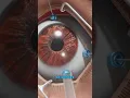 Download Lagu What is a vitrectomy? (3D Animation)