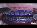 Download Lagu Cleaning Orthodontic Appliances with GBT (Guided Biofilm Therapy)