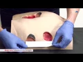 How to Measure a Wound Measuring Wound Dimensions Ausmed Education