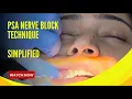 PSA Nerve Block Simplified