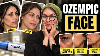 Is Fast Weight Loss Causing Your Ozempic Face?