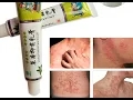 Ifory 3pcs Chinese Ointment Massage Psoriasis Eczema Cream Dermatitis Eczematoid Eczema Ointment