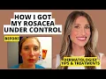 My Rosacea Journey Dermatologist Shares Skincare Treatments That Work Dr Sam Ellis