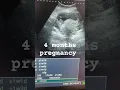 Download Lagu 4 months pregnancy ultrasound #pregnancy #education #ultrasound #baby #obs #pregnant #study