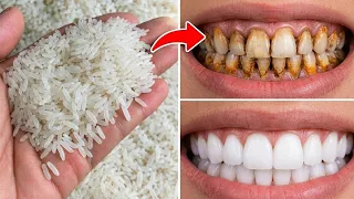 The secret that dentists are hiding from us🔥!It whitens teeth and eliminates tartar.