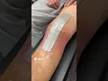 Day 1 Knee Replacement