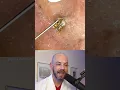 Derm reacts to massive blackhead removal